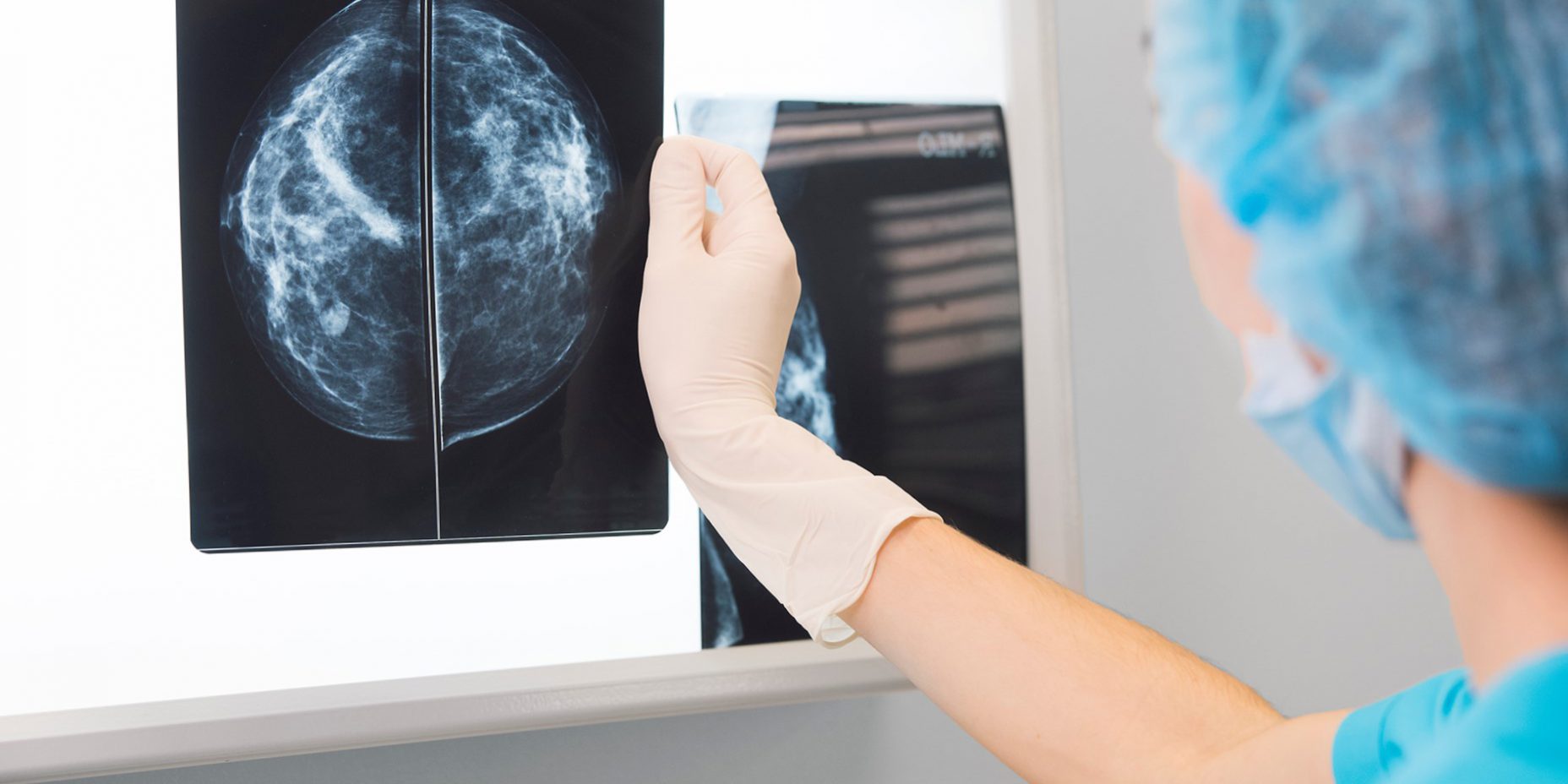 mamografía en Toledo – resultados mamografía en Toledo - resultados