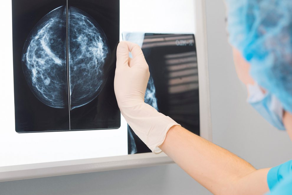 mamografía en Toledo - resultados