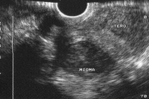 tratamiento de miomas uterino por ultrasonidos en Toledo - diagnóstico