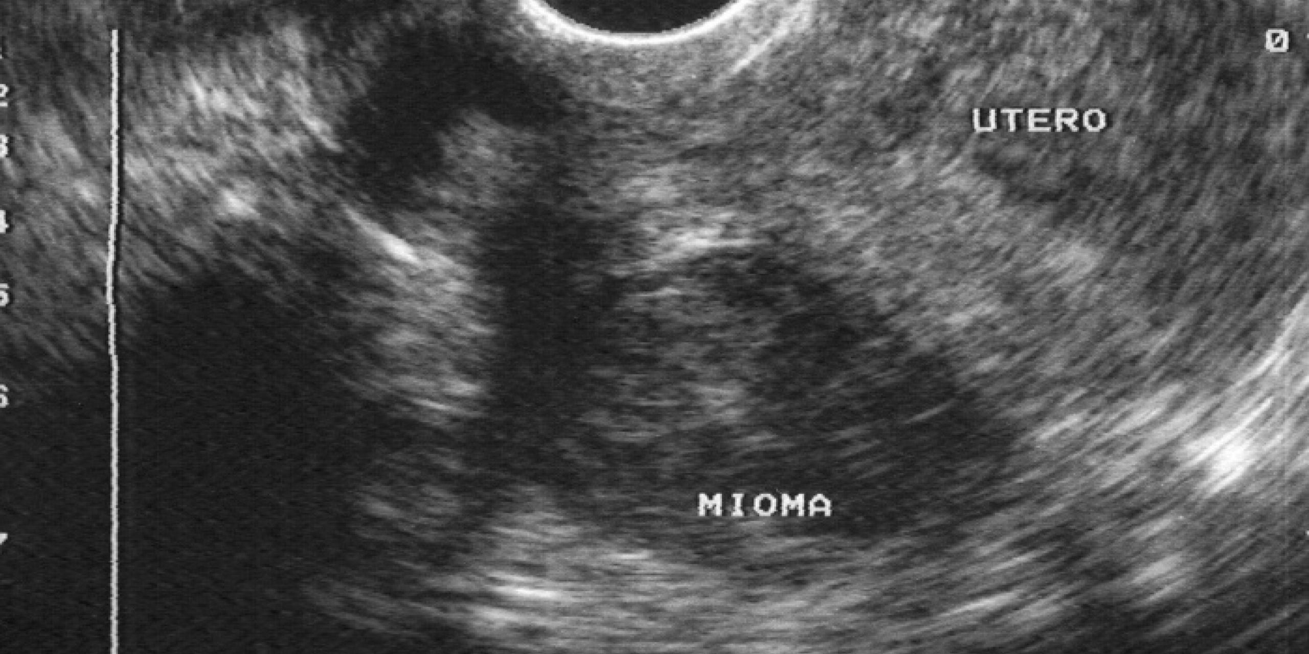 tratamiento-de-miomas-uterinos-por-radiofrecuencia-en-toledo-dra